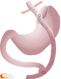 G_bypass_200x260